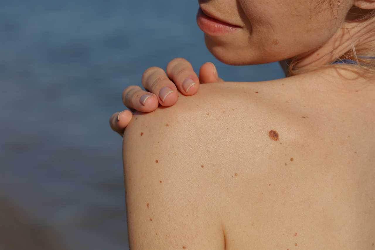 I’m a mole specialist – these are the skin cancer signs I’m looking for