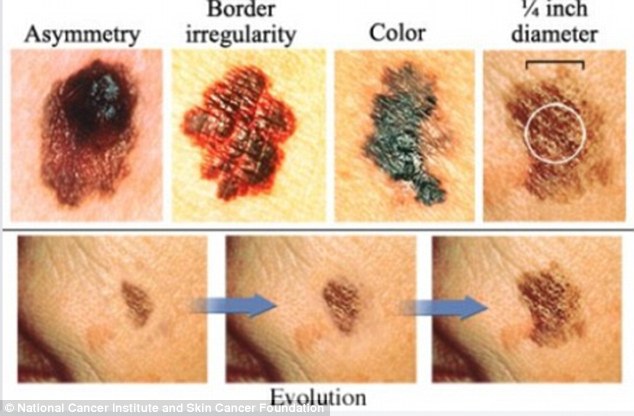 I’m a mole specialist – these are the skin cancer signs I’m looking for