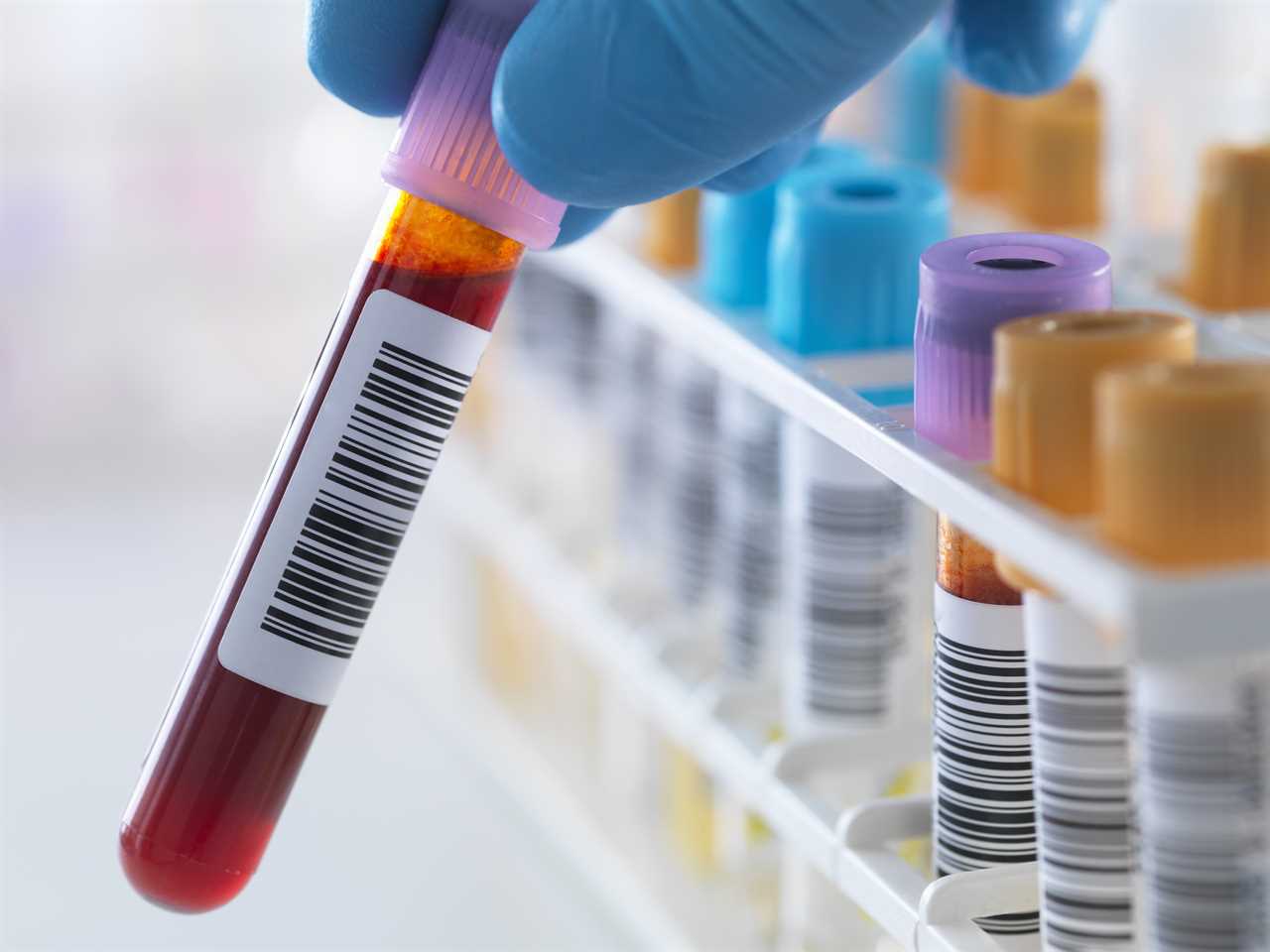 Breakthrough for prostate cancer as new simple blood test is 94% accurate
