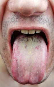 The sign on your tongue that could be cancer – and 4 other symptoms to know