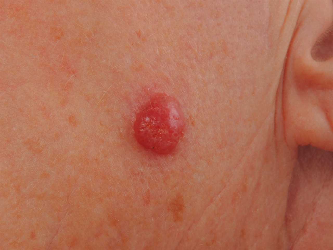 Can you spot the deadly moles from the harmless ones? The skin cancer signs you must never ignore