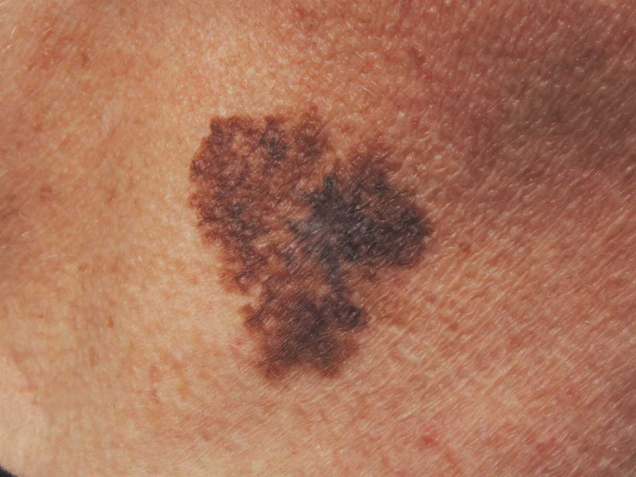 Can you spot the deadly moles from the harmless ones? The skin cancer signs you must never ignore