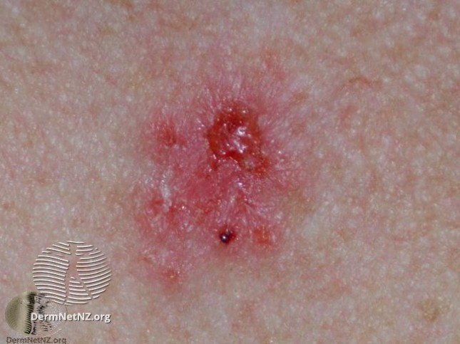 Can you spot the deadly moles from the harmless ones? The skin cancer signs you must never ignore