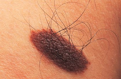 Can you spot the deadly moles from the harmless ones? The skin cancer signs you must never ignore