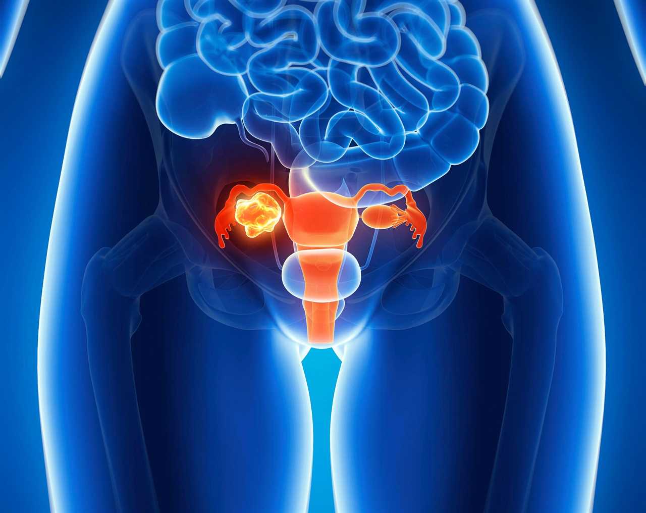 The test picked up 90 per cent of ovarian cancers