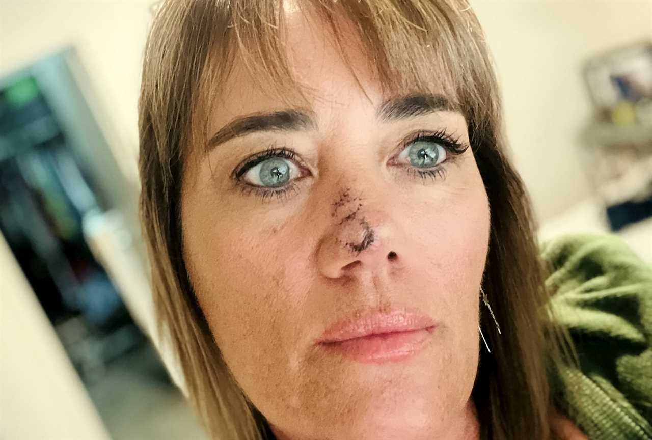 I’m 52 and thought I was too old for zits – but squeezing it led to the discovery I had cancer