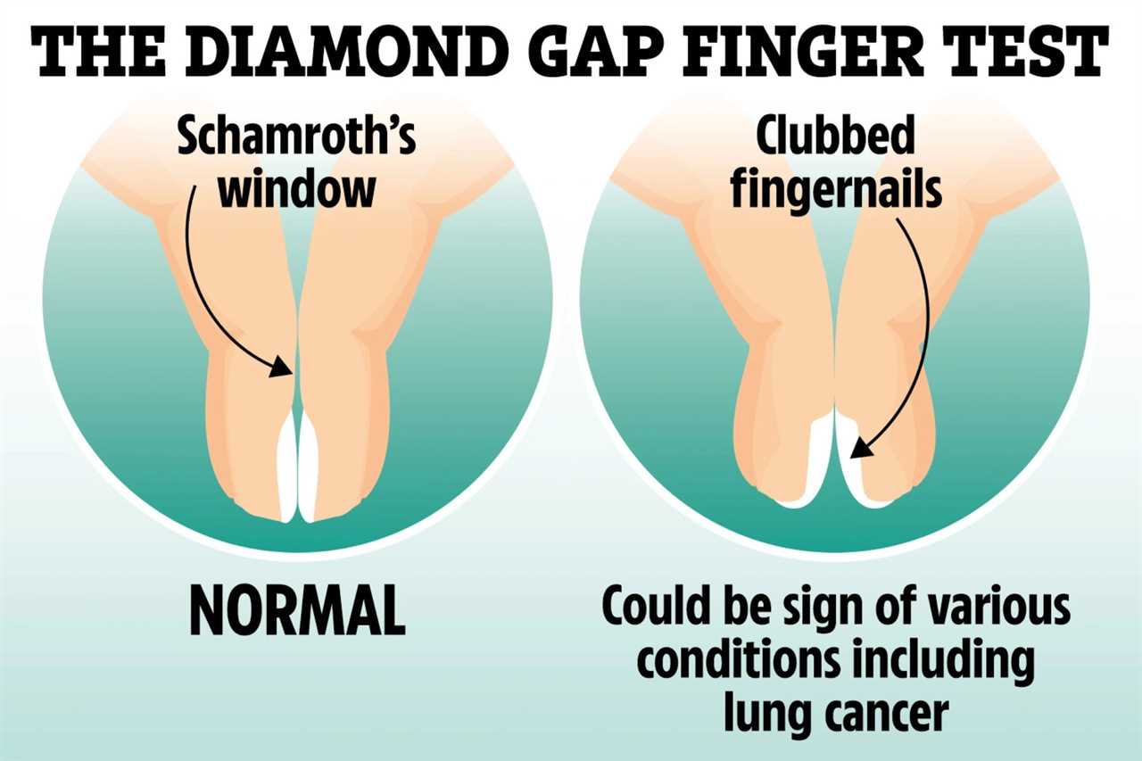 How easy ‘diamond gap’ test can reveal if you’re at risk of deadly lung cancer