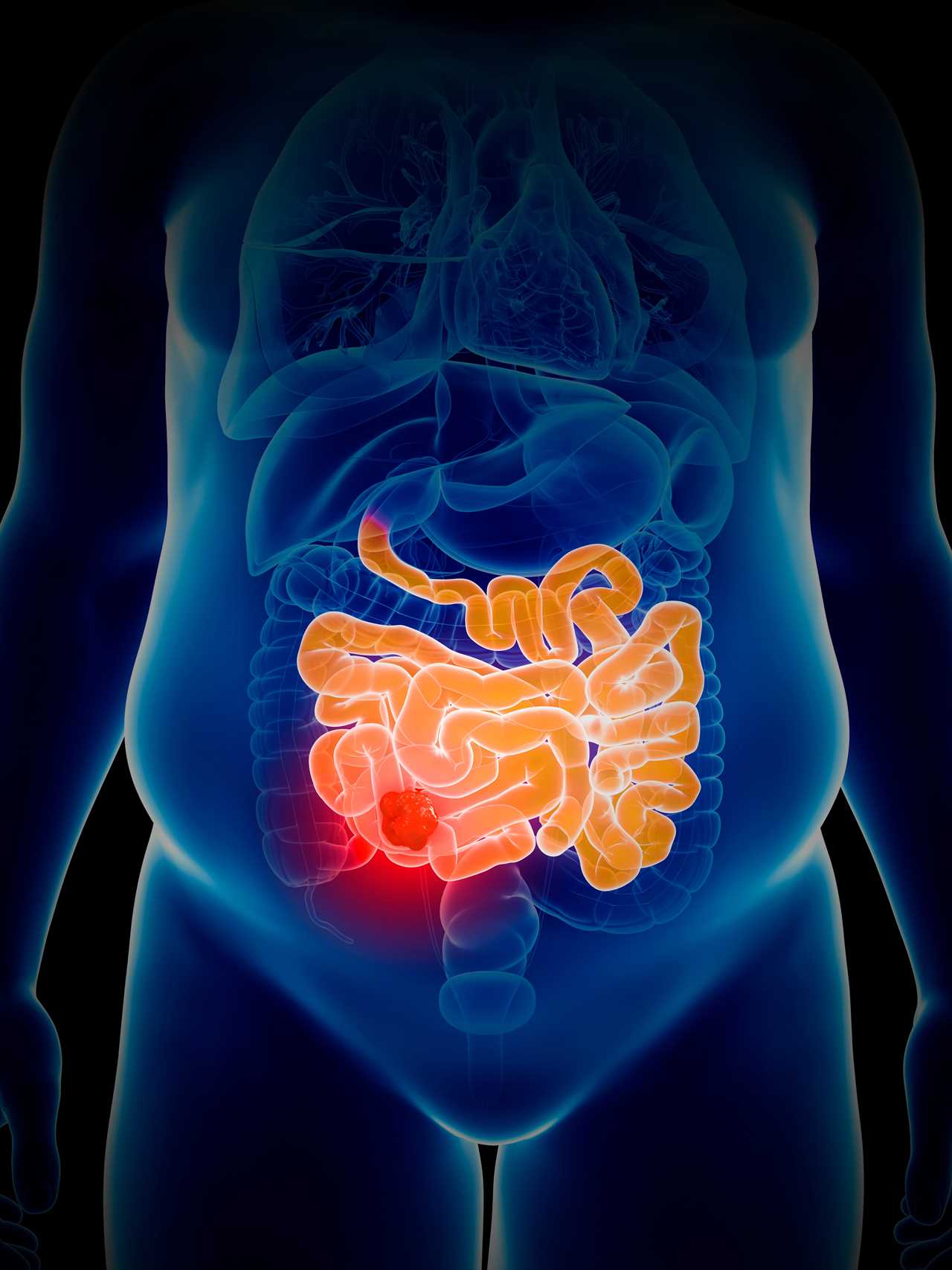 Bowel cancer treatment breakthrough as scientists solve decades-long immune system mystery