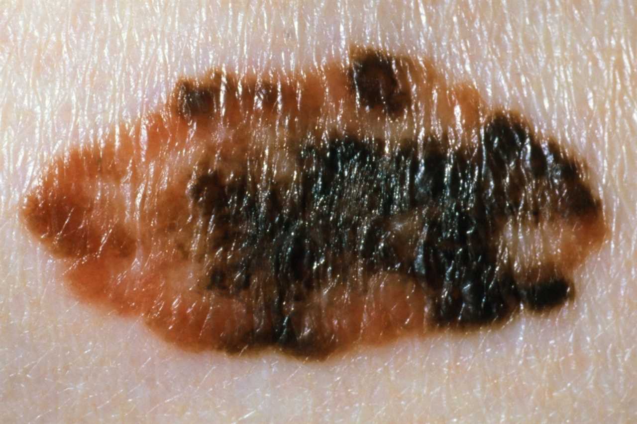 I’m a GP – the changes in your moles that could mean you’ve got skin cancer
