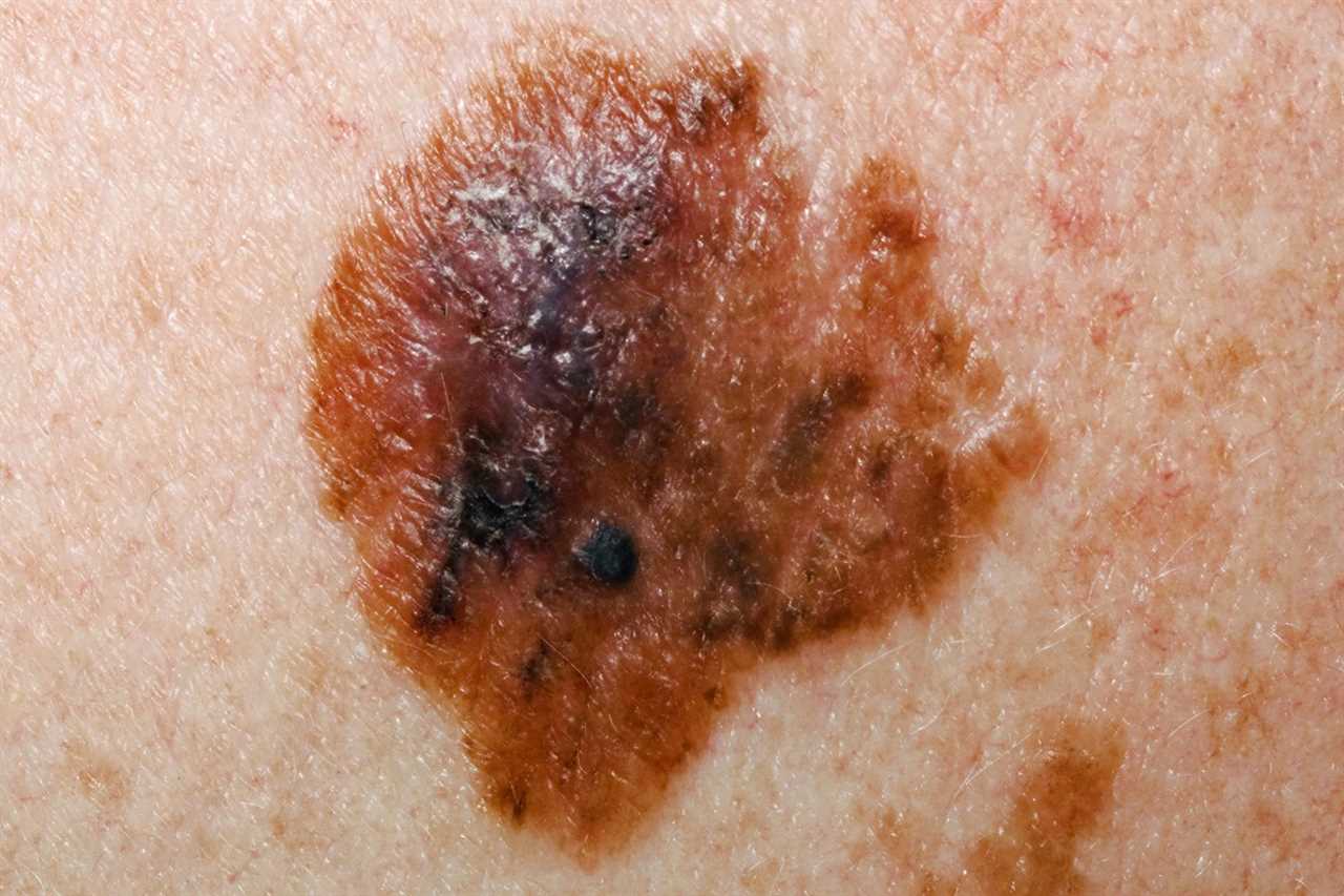 I’m a GP – the changes in your moles that could mean you’ve got skin cancer