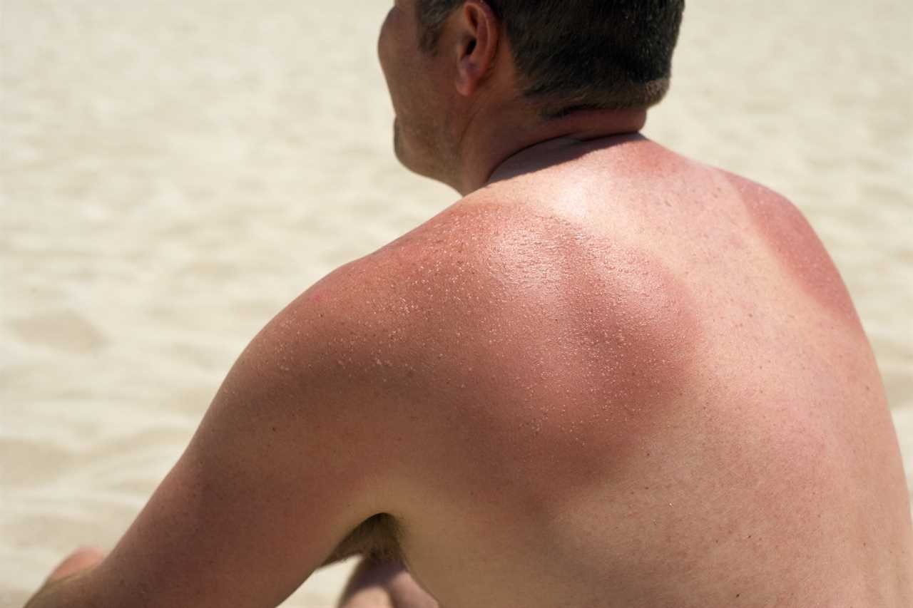 Urgent warning as killer skin cancer cases reach record high – the 4 signs your moles are a risk