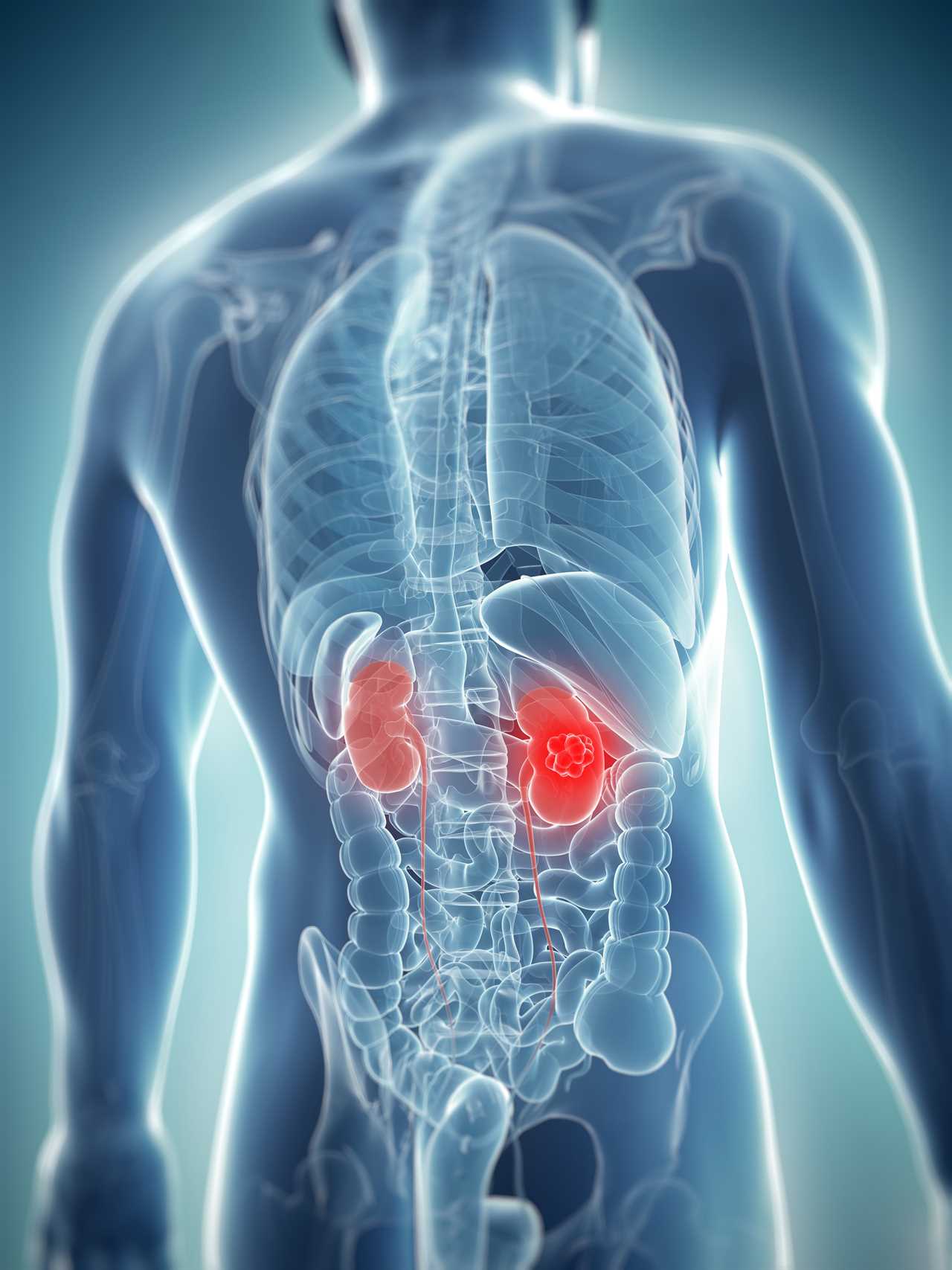 The ‘silent’ symptom of killer kidney cancer that strikes at night – and 6 other signs you must never ignore