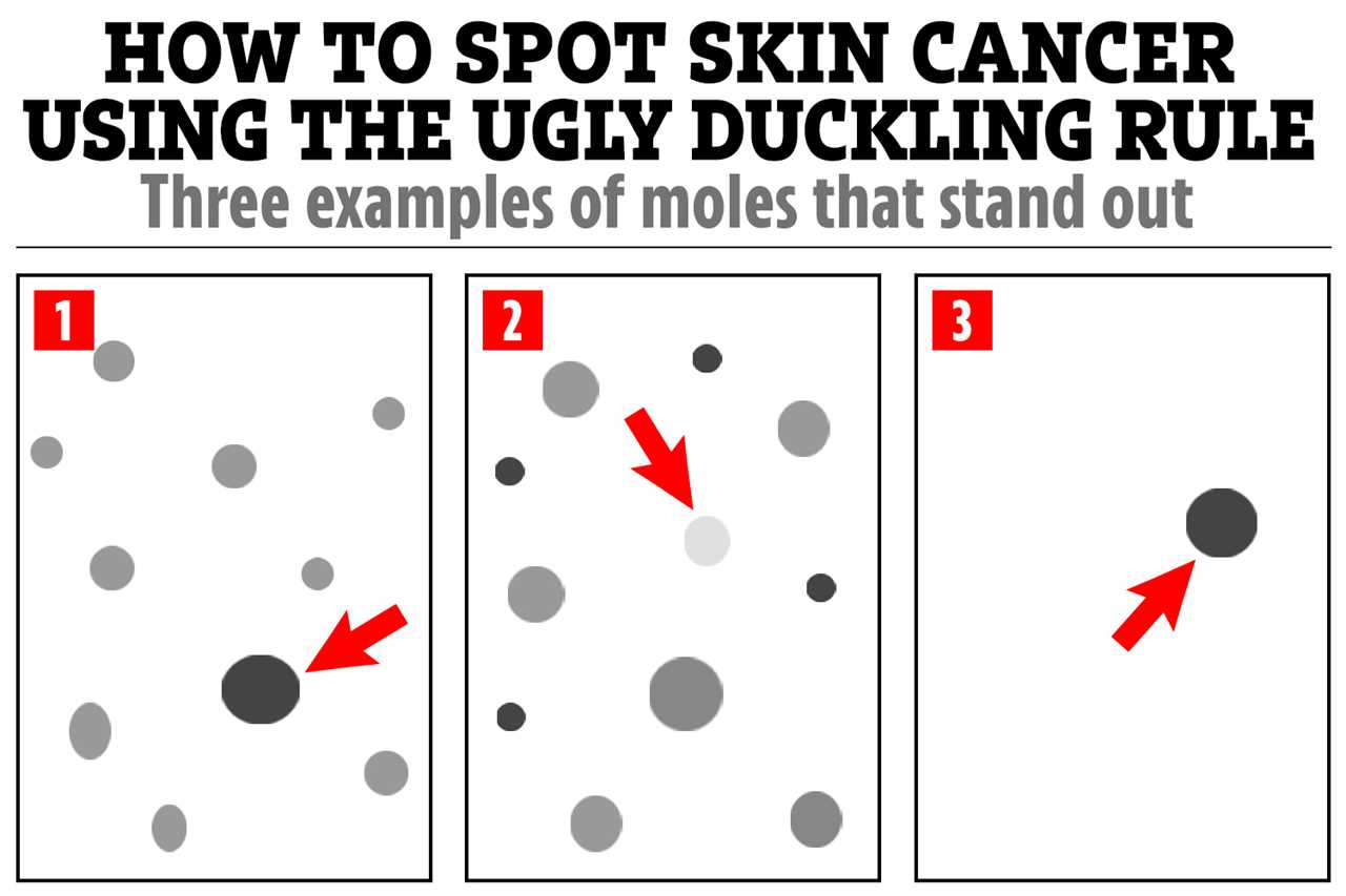 How to Spot Skin Cancer Using the Ugly Duckling Rule Amid UK Heatwave