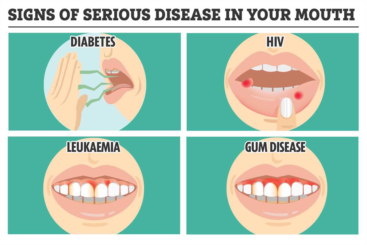 Signs of Serious Disease Hiding in Your Mouth – From Cancer to HIV and How to Check