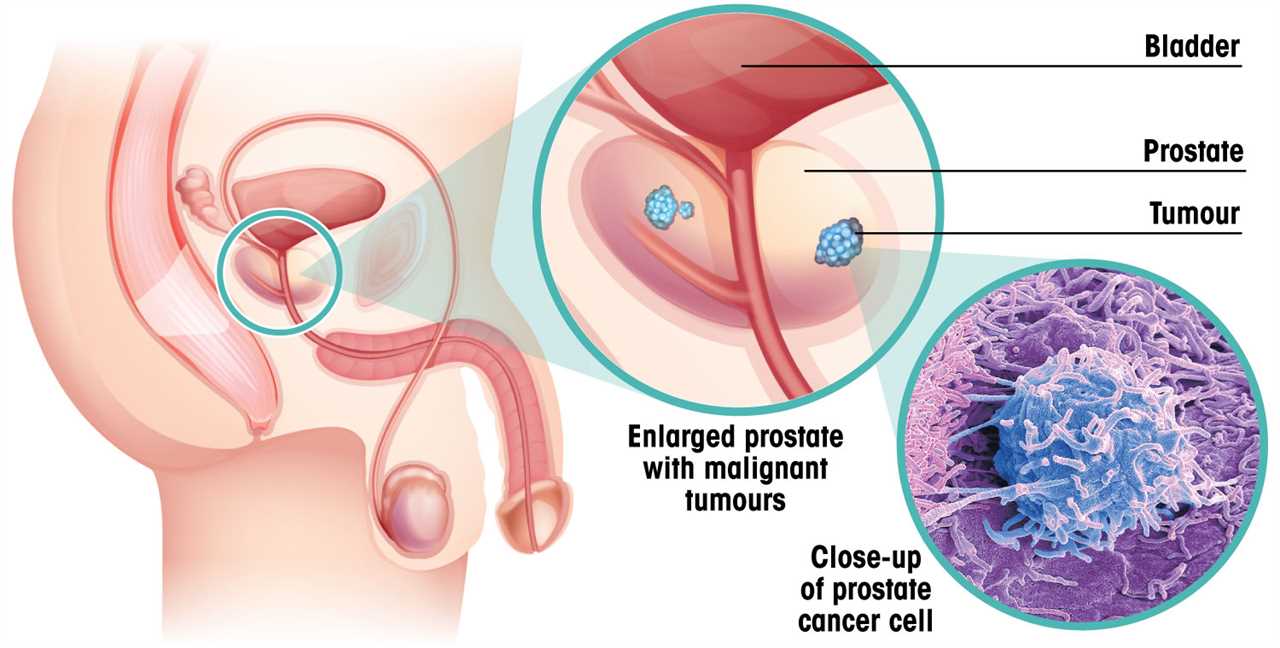 The 6 Early Signs of Prostate Cancer All Men Should Know About