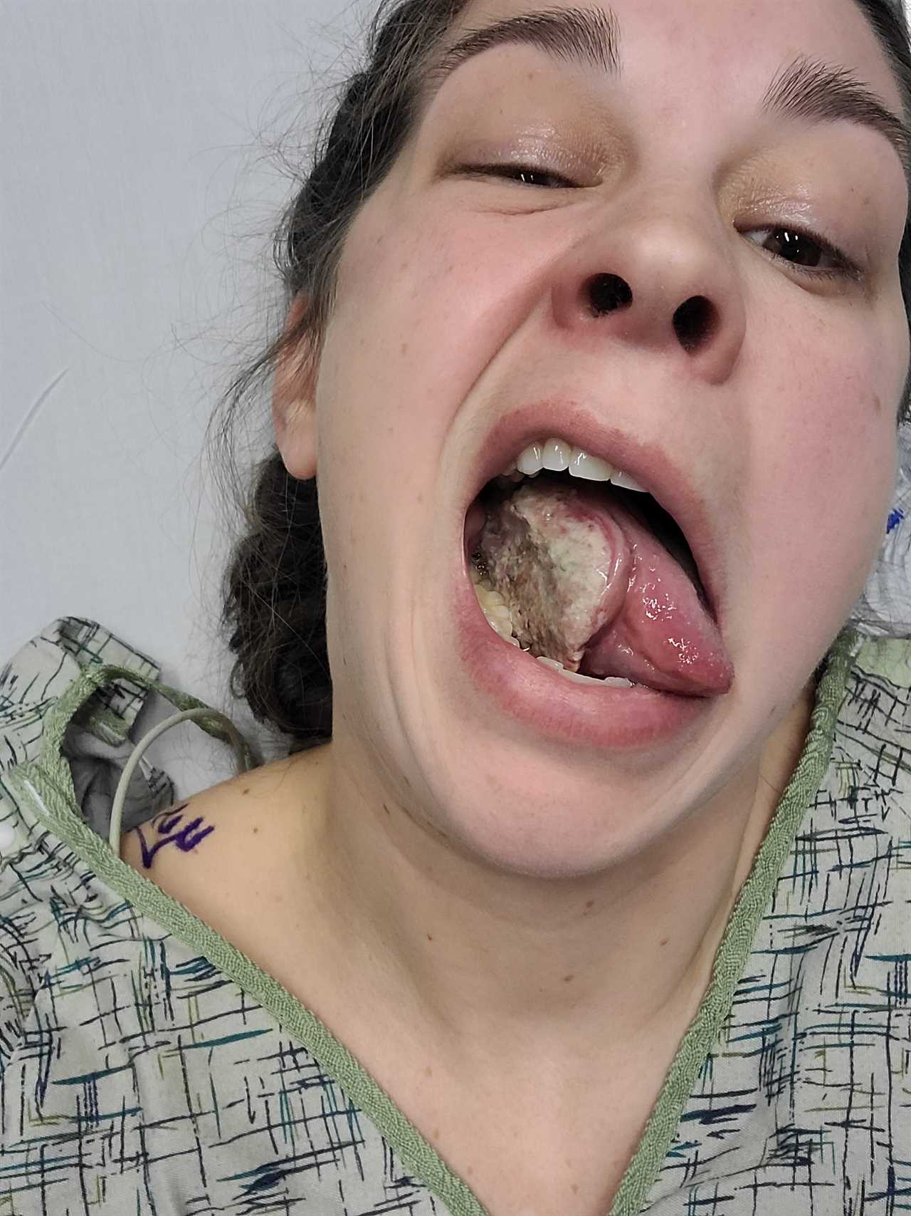 Mum Shocked by Stage Four Tongue Cancer Diagnosis