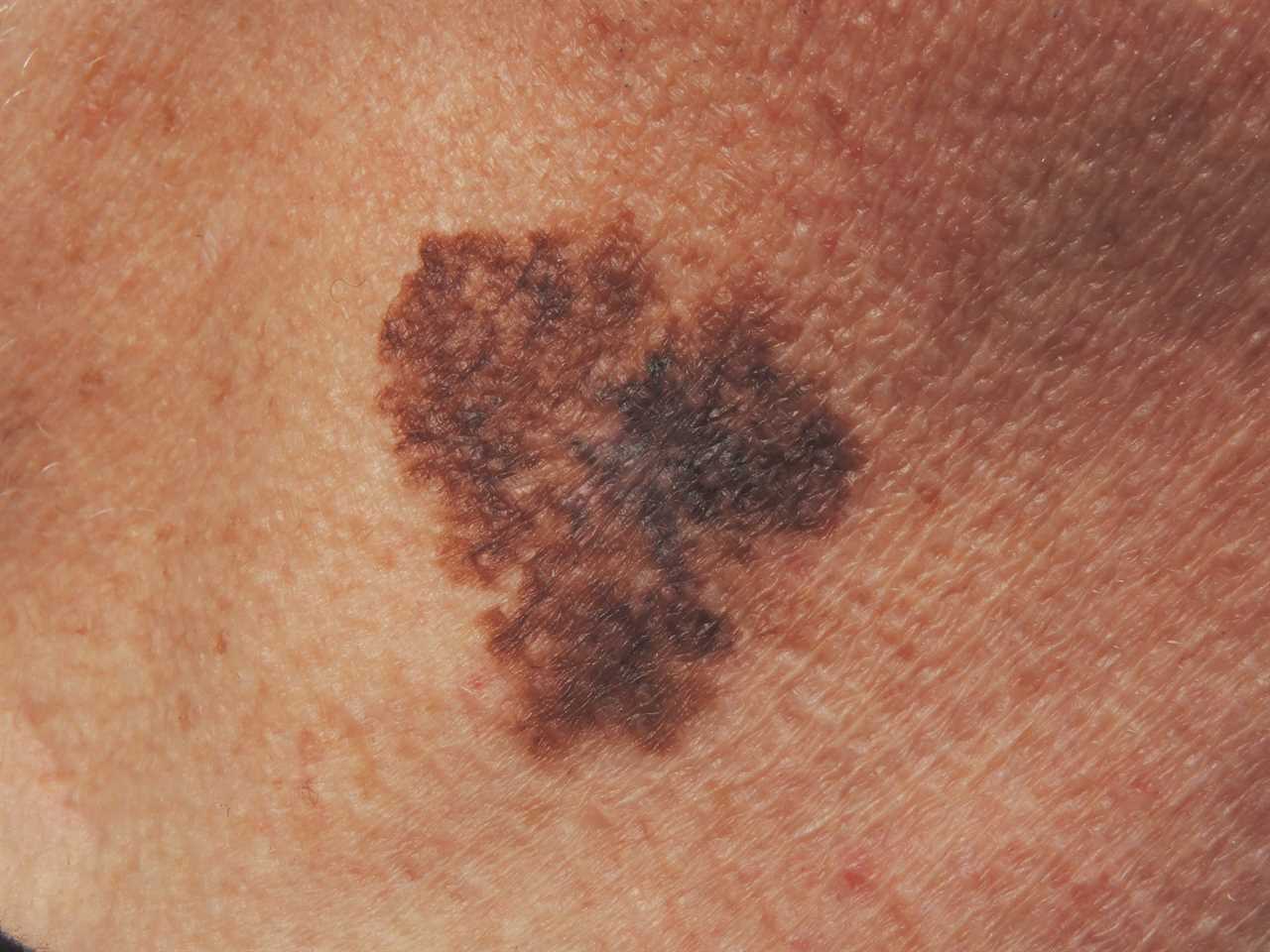 The Four Signs of Melanoma Everyone Must Know as Sarah Ferguson Reveals Skin Cancer Diagnosis