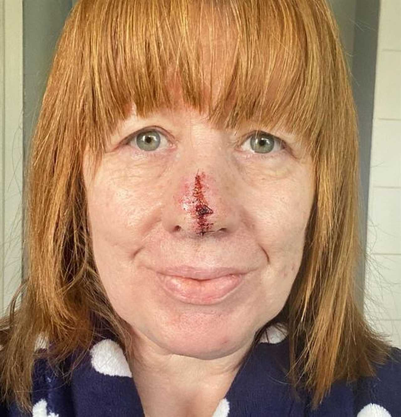 Mum Loses Part of Nose After Cancer Misdiagnosis