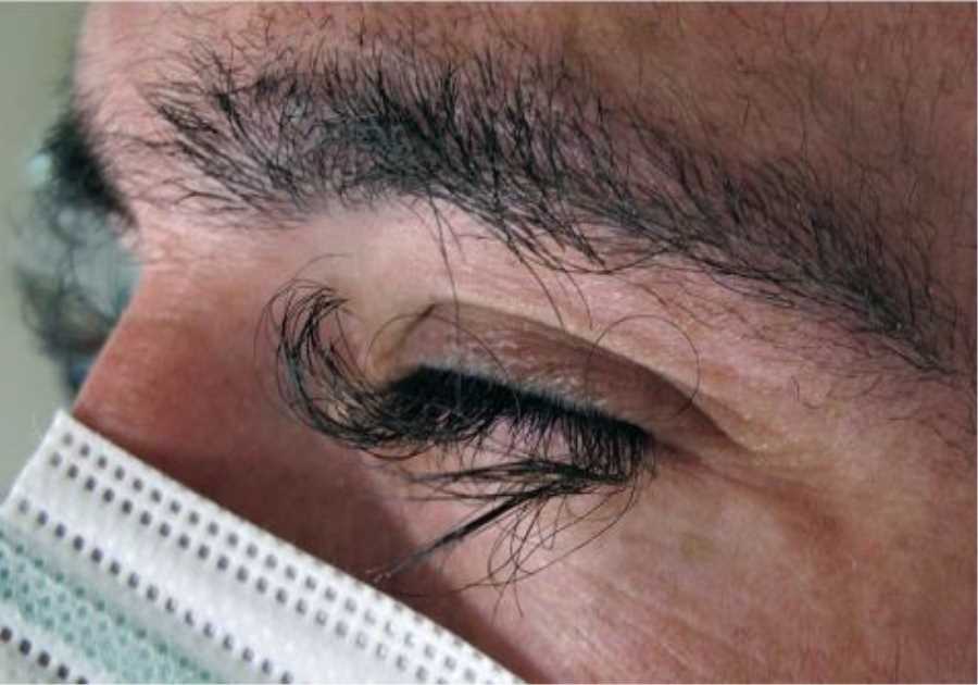 Man's Eyelashes Grow Overgrown and Curly Due to Cancer Treatment