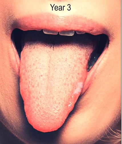 Shocking Time-lapse Video Reveals Tongue Cancer Transformation