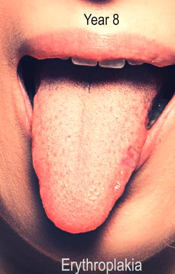 Shocking Time-lapse Video Reveals Tongue Cancer Transformation