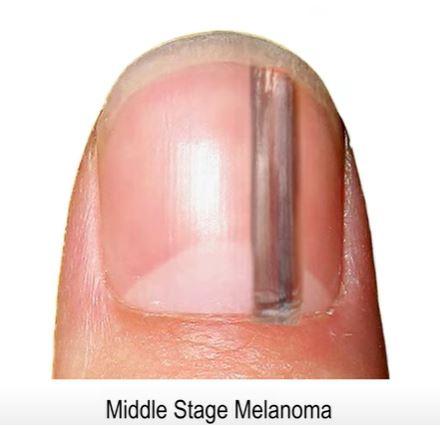Horrifying Time-Lapse Video Reveals Nail 'Blemish' Can Turn into Stage 4 Cancer