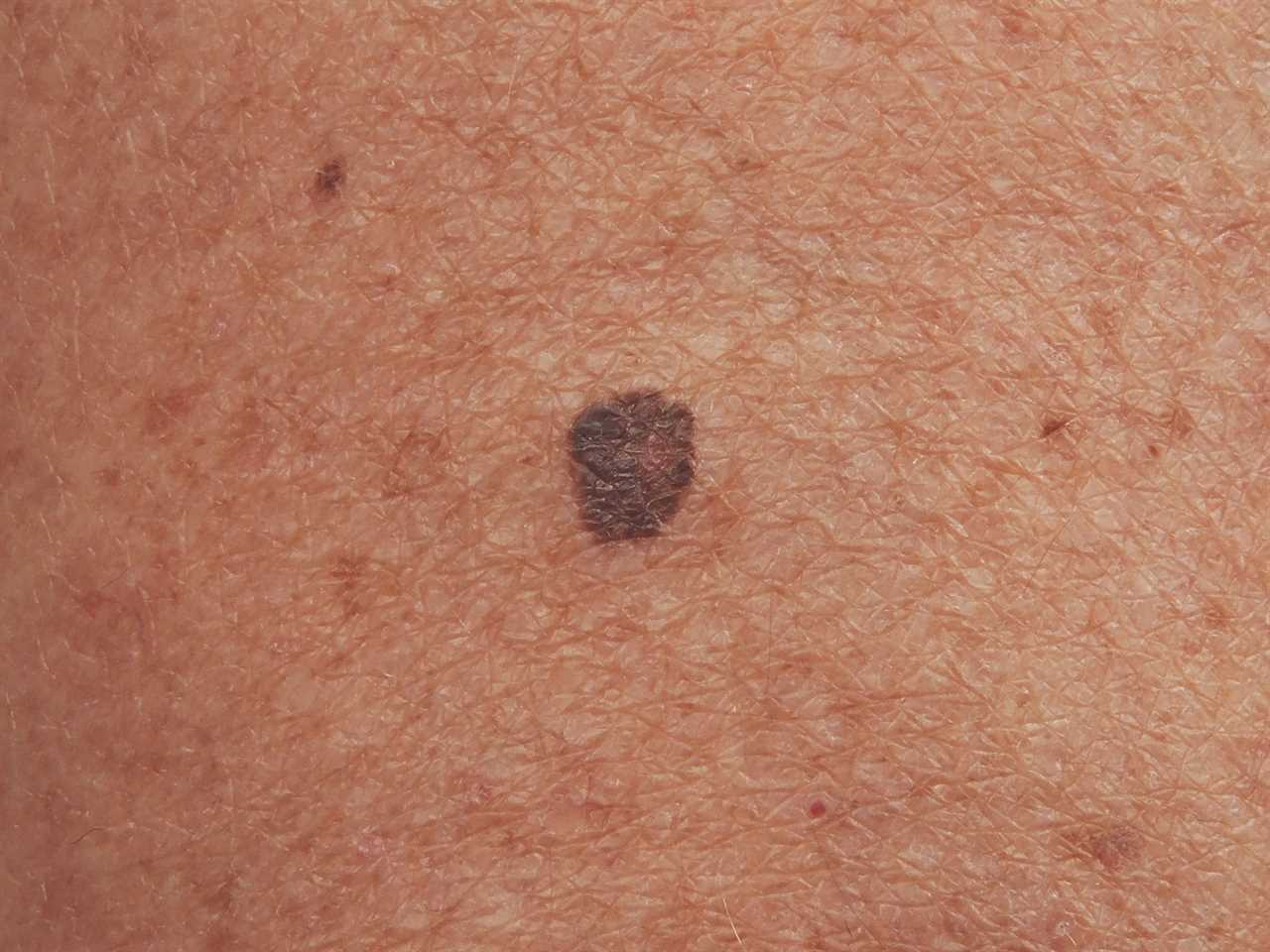 Skin Cancer Signs: What You Need to Know