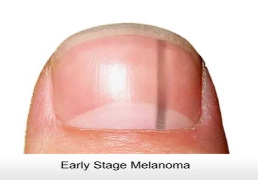 Horrifying Time-Lapse Video Reveals Nail 'Blemish' Can Turn into Stage 4 Cancer