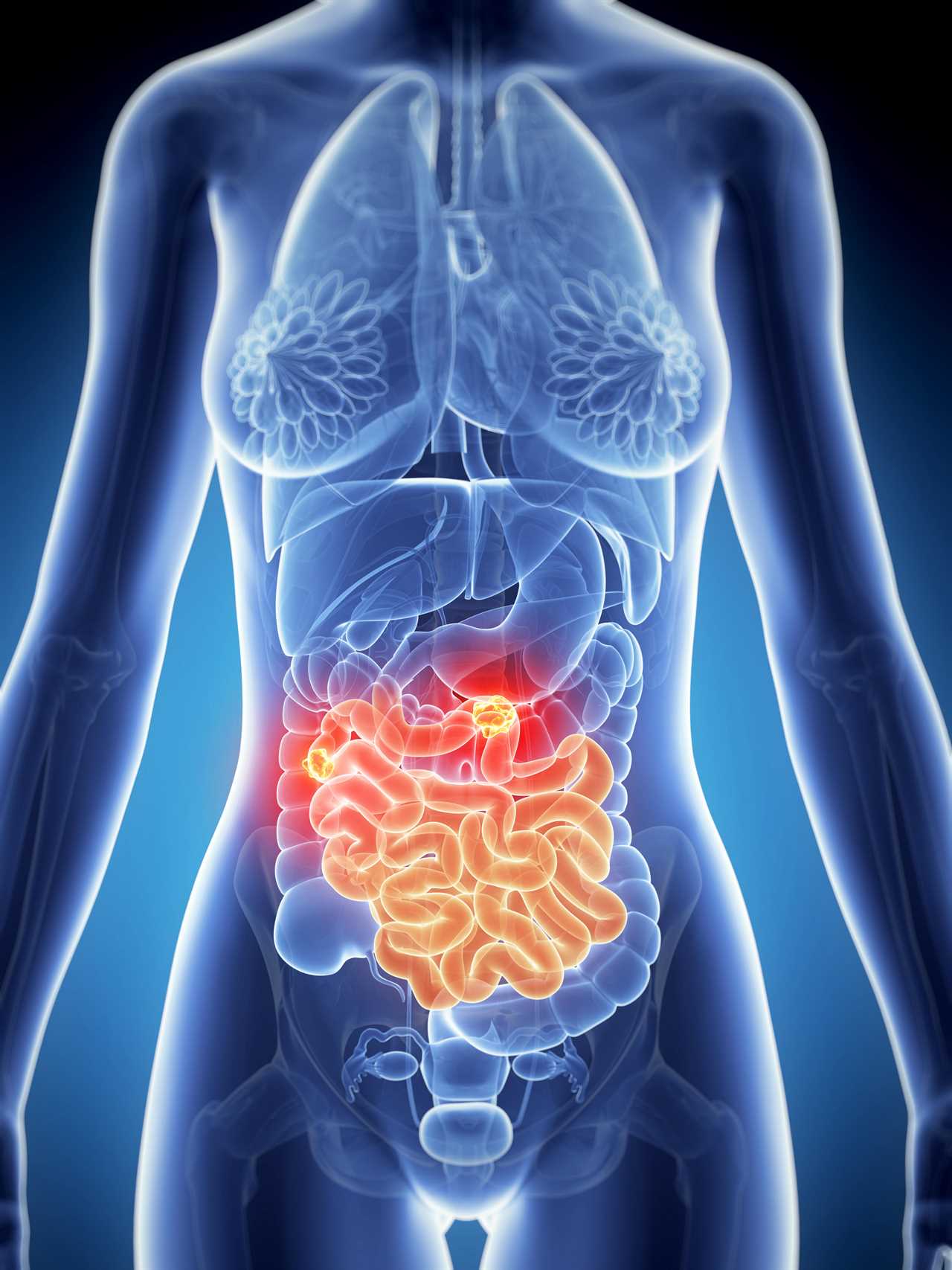 'Remarkable' Bowel Cancer Drug Shows 100% Effectiveness