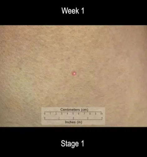 Shocking time-lapse video reveals skin cancer progression