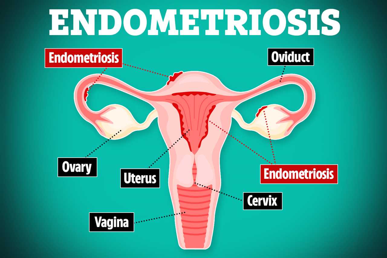 Link Between Endometriosis and Ovarian Cancer Risk Revealed in New Study