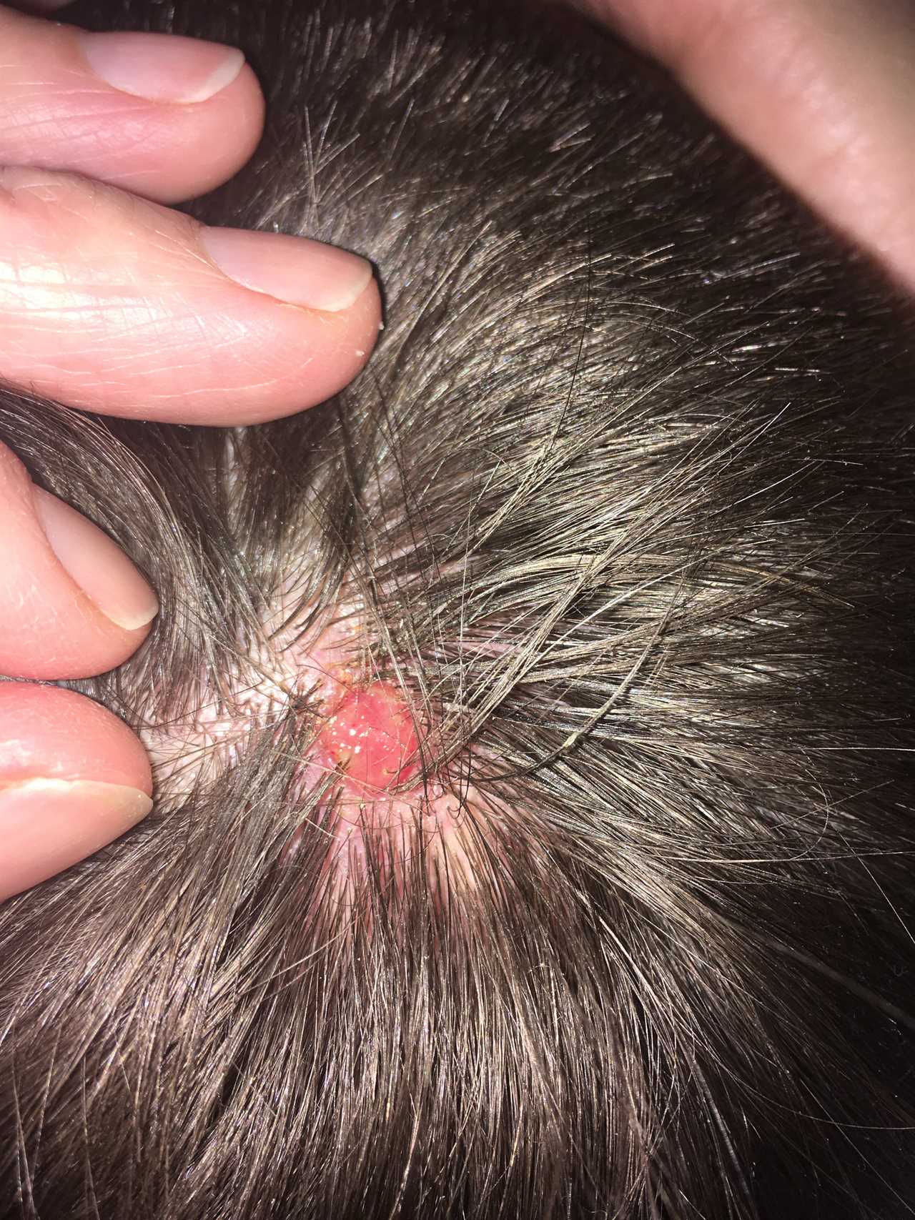 Man's Shocking Melanoma Discovery on Scalp