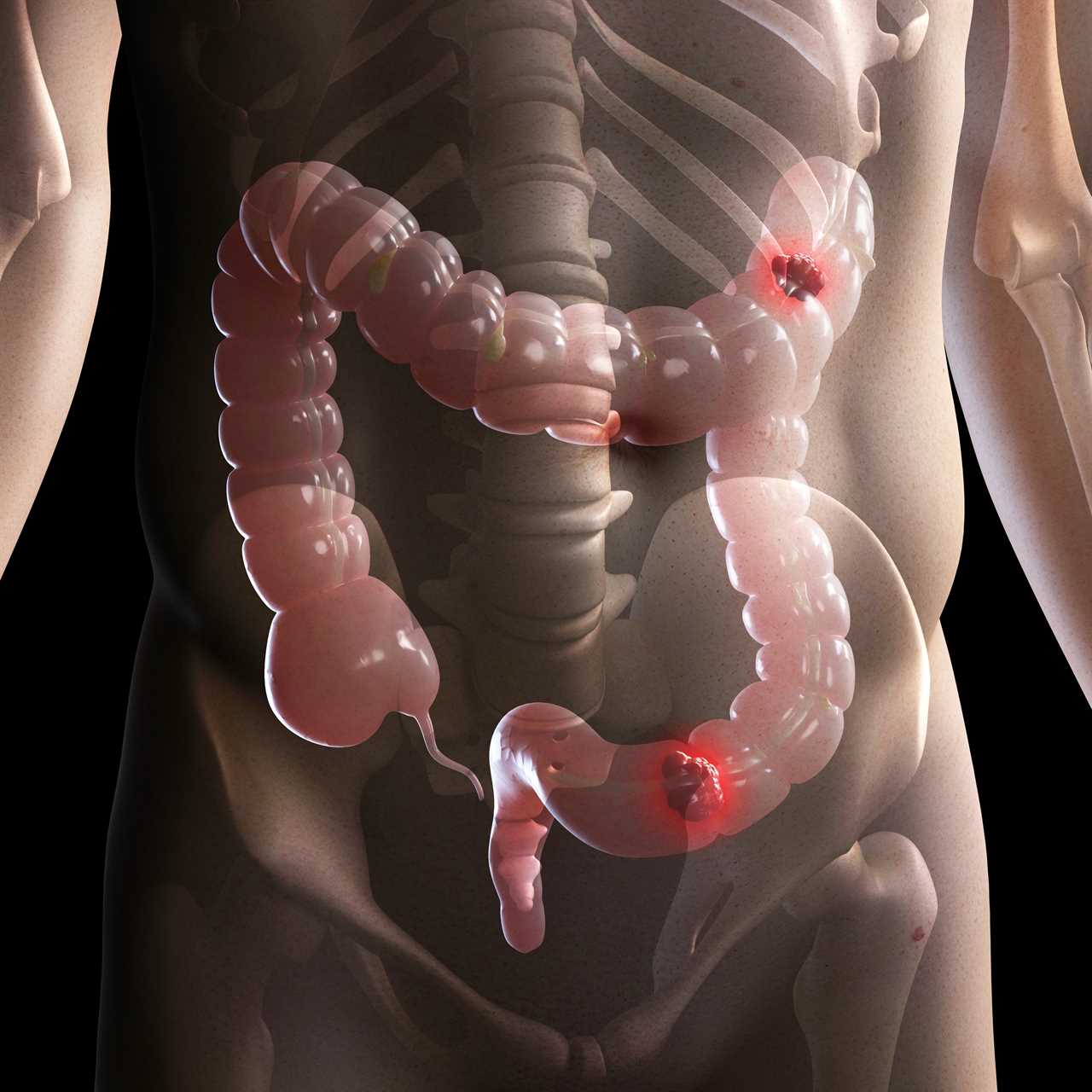 Breakthrough Study: New Method Predicts Bowel Cancer Risk with Over 90% Accuracy