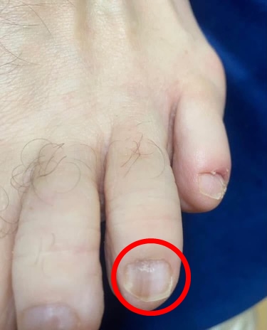 Woman discovers husband's cancer through subtle toenail sign dismissed by doctors