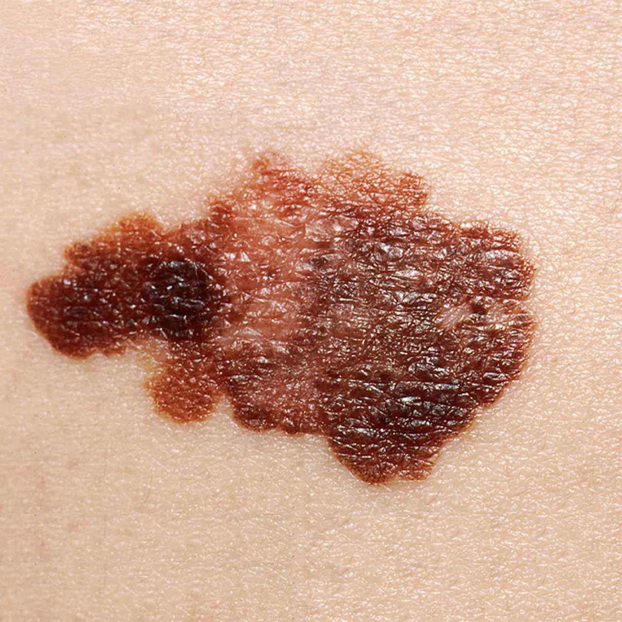 Six Early Warning Signs of Skin Cancer You Should Never Ignore