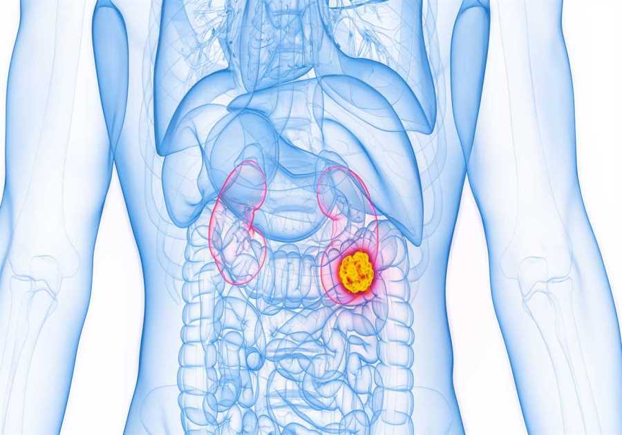 Chilling report reveals four in five kidney cancer cases spotted by accident