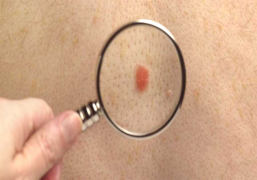 Six Early Warning Signs of Skin Cancer You Should Never Ignore