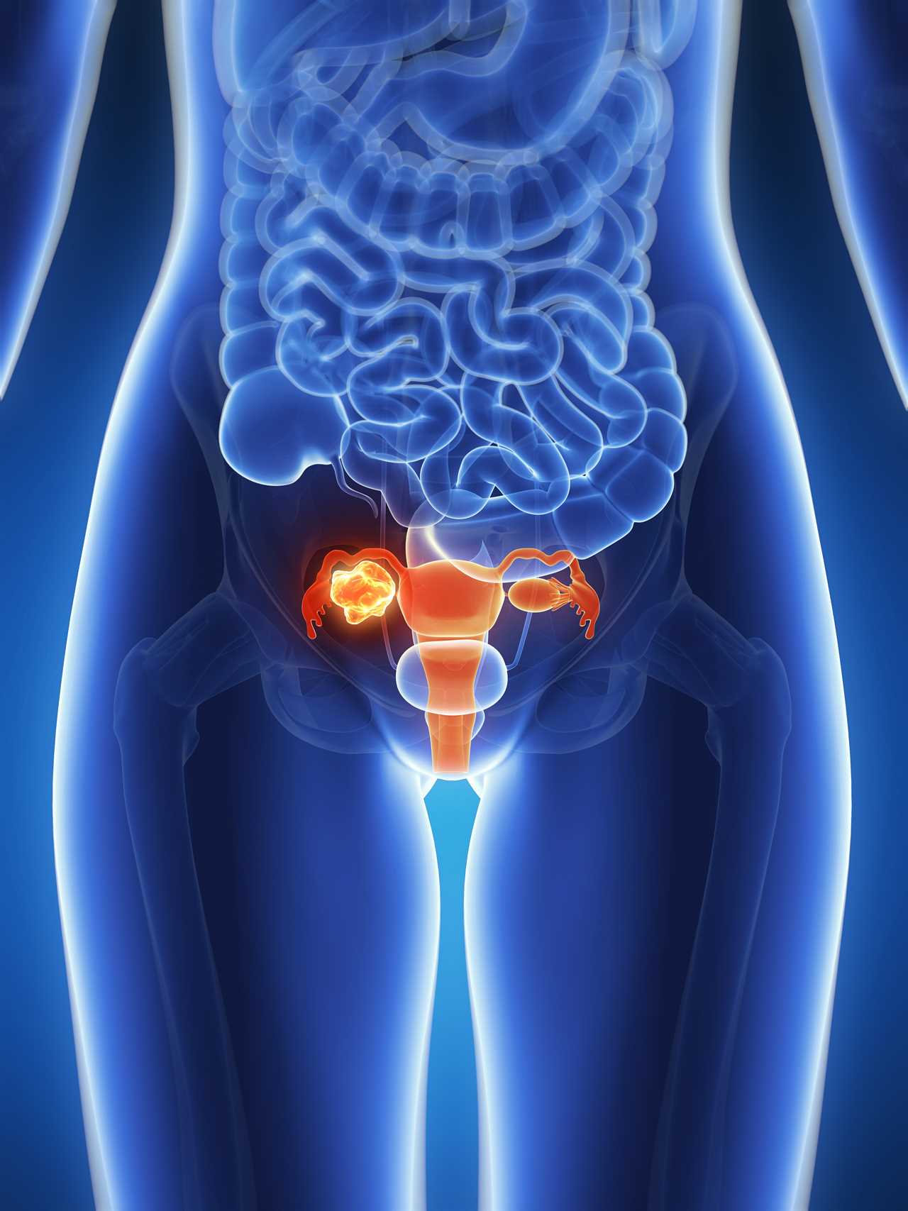 The 4 ‘Silent Signs’ of Ovarian Cancer You Should Never Ignore