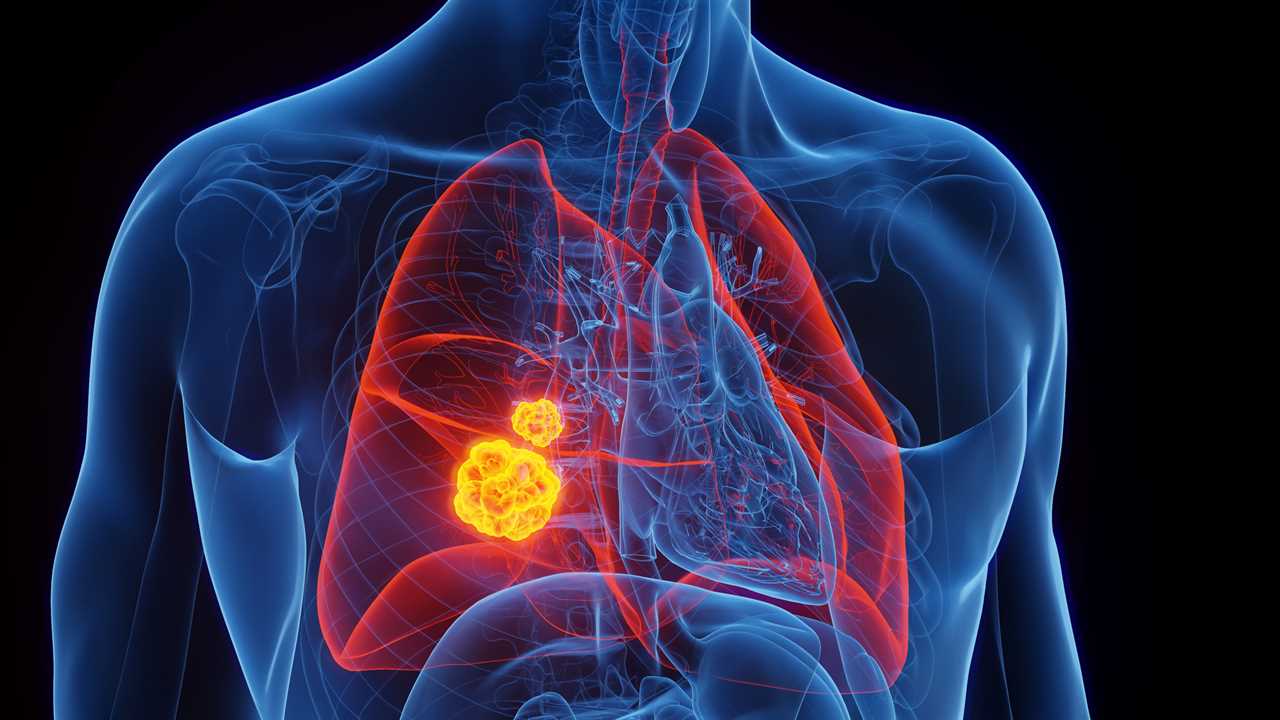 Study Reveals Link Between Diet and Lung Cancer Risk