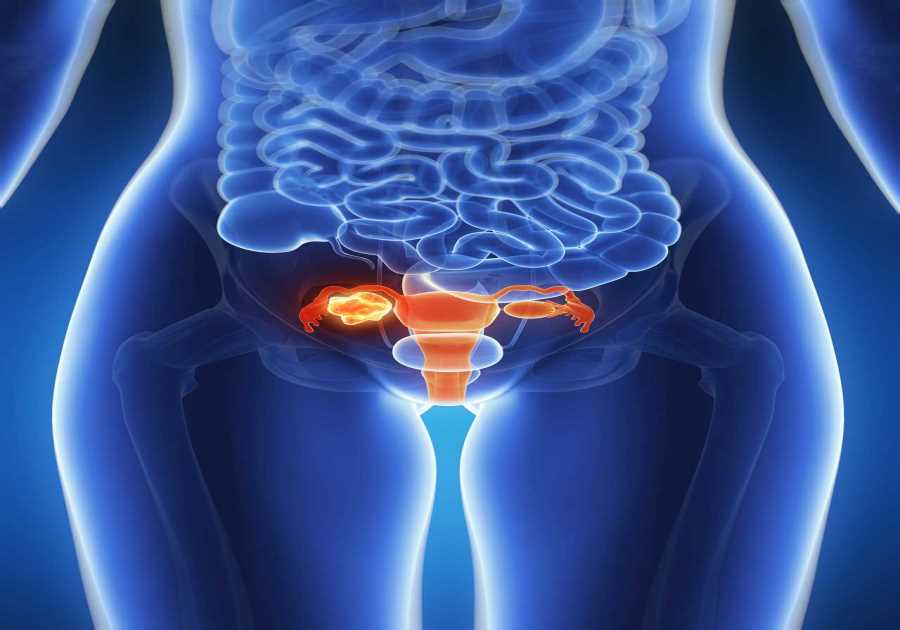 The 4 ‘Silent Signs’ of Ovarian Cancer You Should Never Ignore