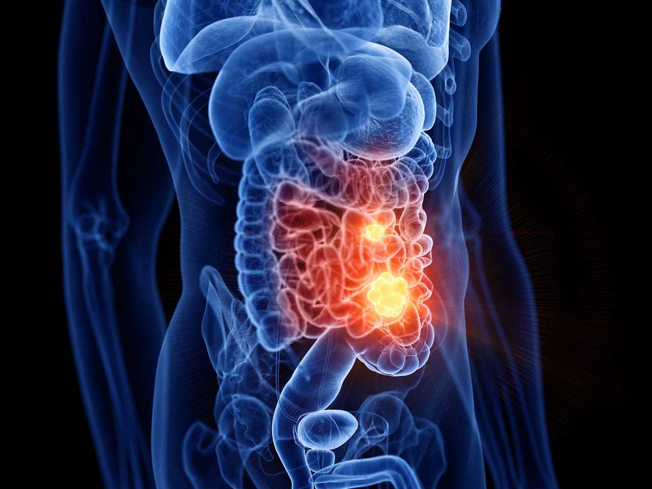 Link Between NAFLD and Bowel Cancer Risk: Unveiling Hidden Health Threats