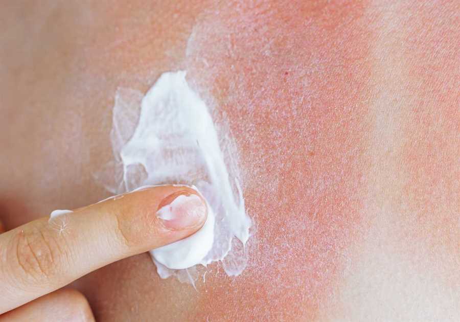 Impact of Sunburn on Skin Cancer Risk: A Troubling Reality