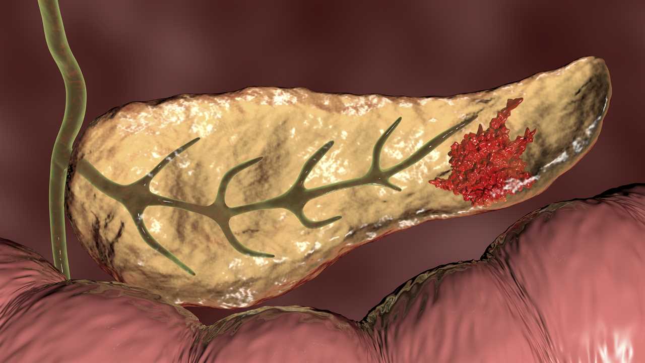 New Vaccine Breakthrough in Pancreatic Cancer Treatment Offers Hope