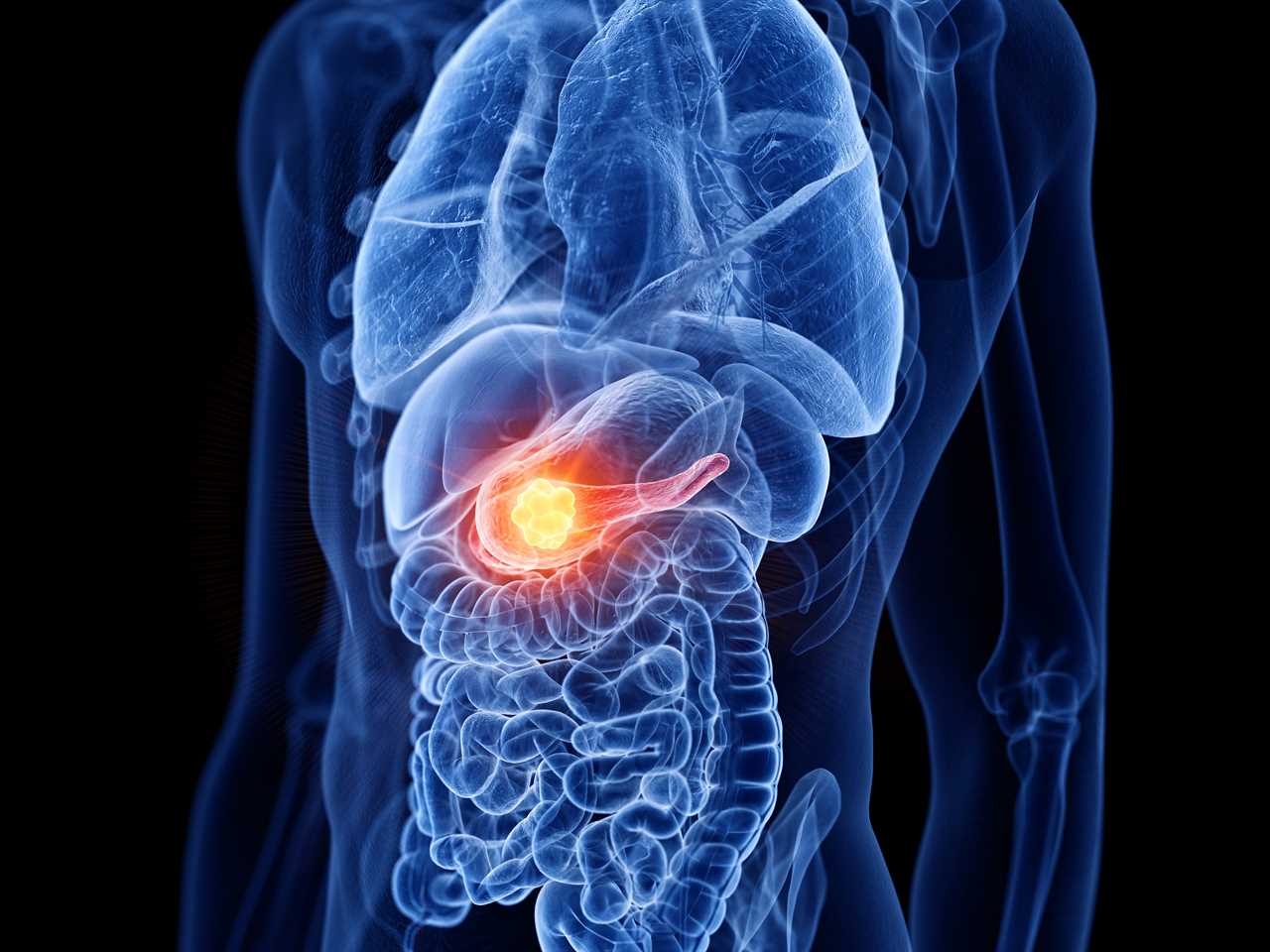 Breakthrough Pancreatic Cancer Blood Test Trial Seeks Participants for Early Detection