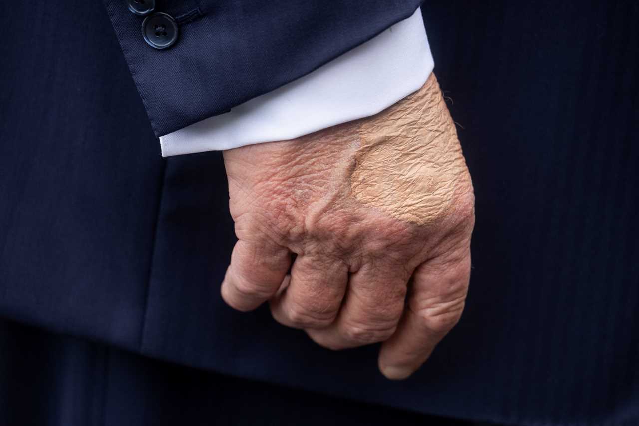 Analysis: Unpacking Donald Trump's Recent Health Concerns and Chronic Condition