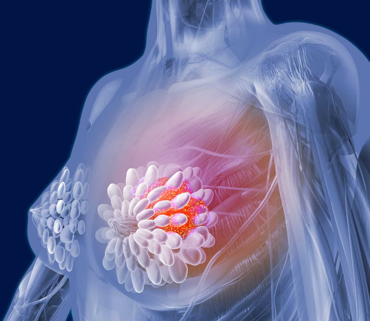 New Discovery Links Weight-Loss Injections to Breast Cancer Prevention