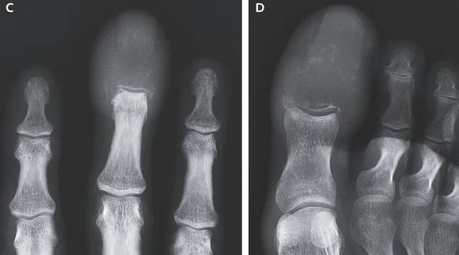 Analytical Exploration: Uncovering the Complexities of Rare Acrometastasis in Cancer