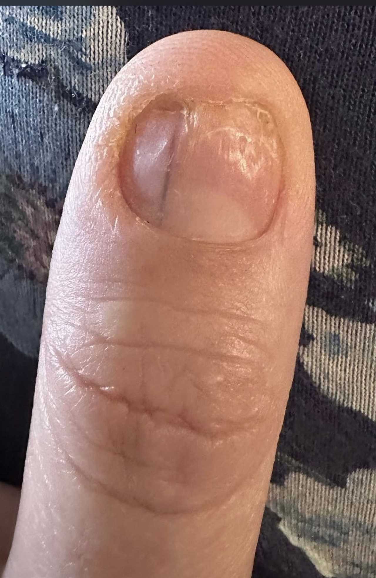 Unveiling Subtle Nail Signs of Deadly Illness: A Call for Vigilance