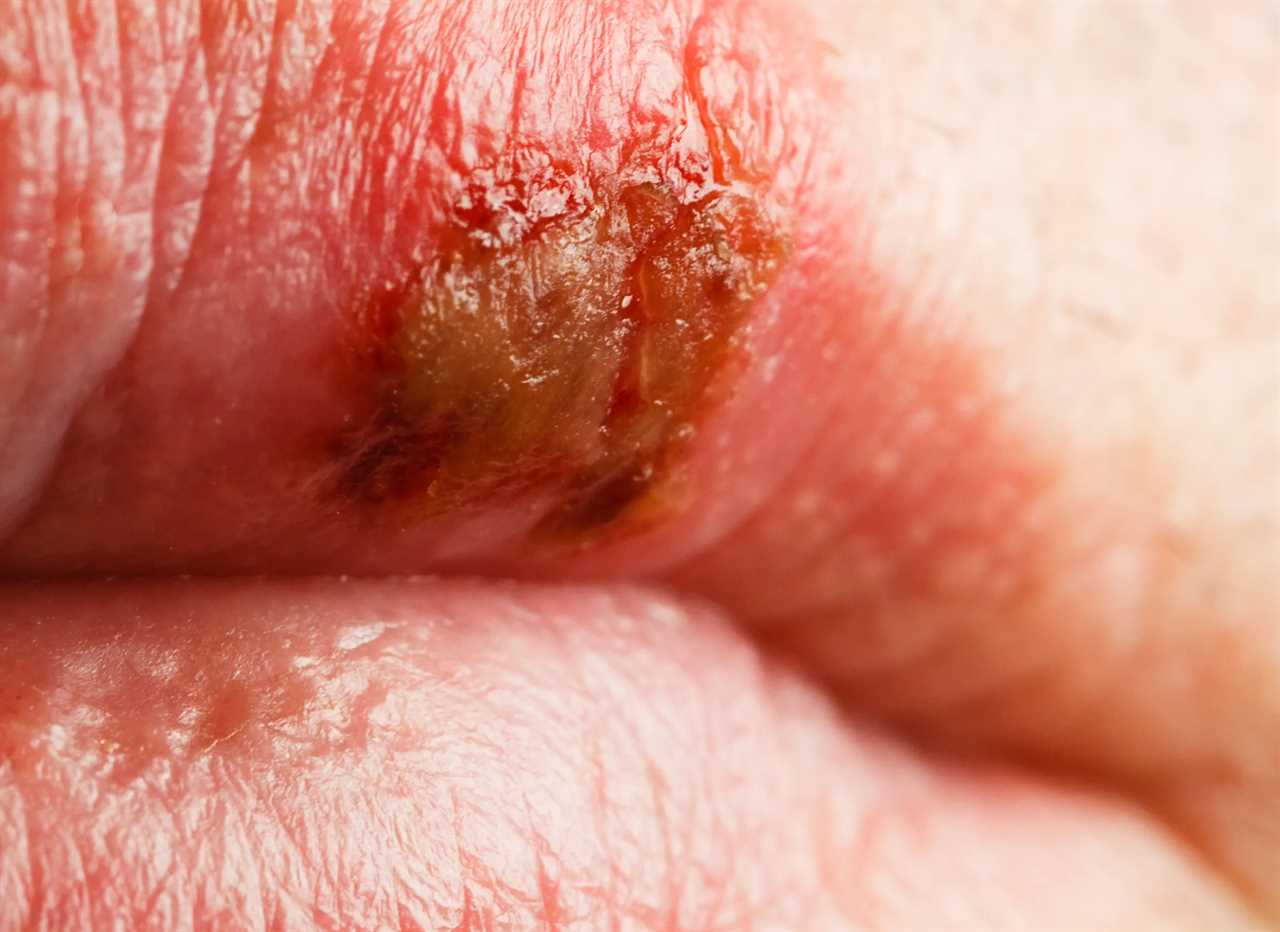 Decoding Lip Health: Insights into Your Well-being Beyond Lipstick